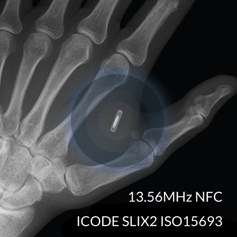 xSLX NFC Implantat